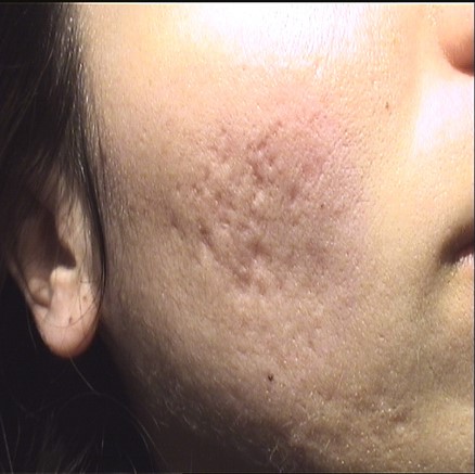 antes-del-resultados-tratamiento-laser-cicatrices-marcas-acne-dr-lopez-gil-clinica-barcelona-teknon