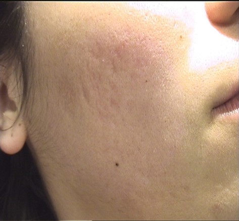 resultados-tratamiento-laser-cicatrices-marcas-acne-dr-lopez-gil-clinica-barcelona-teknon.jpg