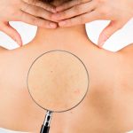 ¿Por qué me salen granos o acné en la espalda (bacné) y cómo eliminarlos?