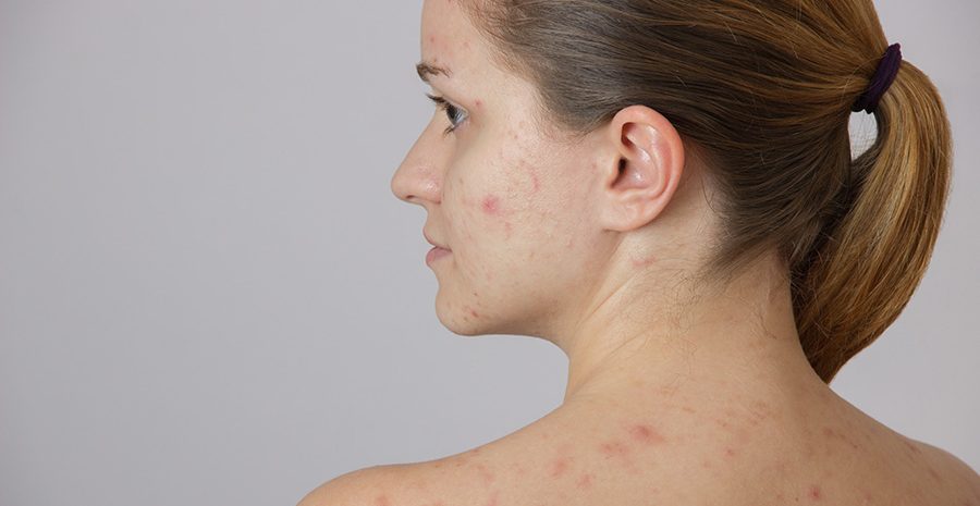 acne-quistico-conglabata-cara-hombros-mujeres-adulta-hormonas-tratamiento-acne-dermatologia-dermatologo-dr-lopez-gil-gil-clinica-teknon-barcelona