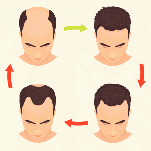 alopecia-androgenetica-masculina-escala-hamilton-evolucio-cabello-caida-dermatologia-dermatologo-dr-lopez-gil-clinica-teknon-barcelona