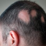 Alopecia areata, combátela con los mejores tratamientos. El Dr. López Gil te los explica:
