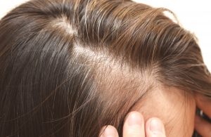 cabello-pelo-caida-alopecia-areata-vitaminas-dermatologia-dermatologo-dr-lopez-gil-clinica-teknon-barcelona