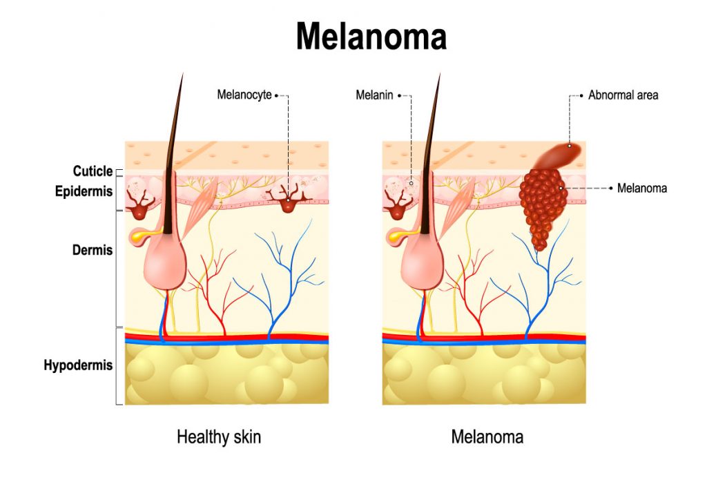 melanoma_cancer_pell_dermatologia_dermatologo_drlopezgil_dermandtek_teknon_barcelona_andorra