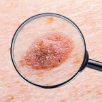 Todo lo que tienes que saber sobre el melanoma. Signos y síntomas para prevenir y evitar el cáncer de piel. 
