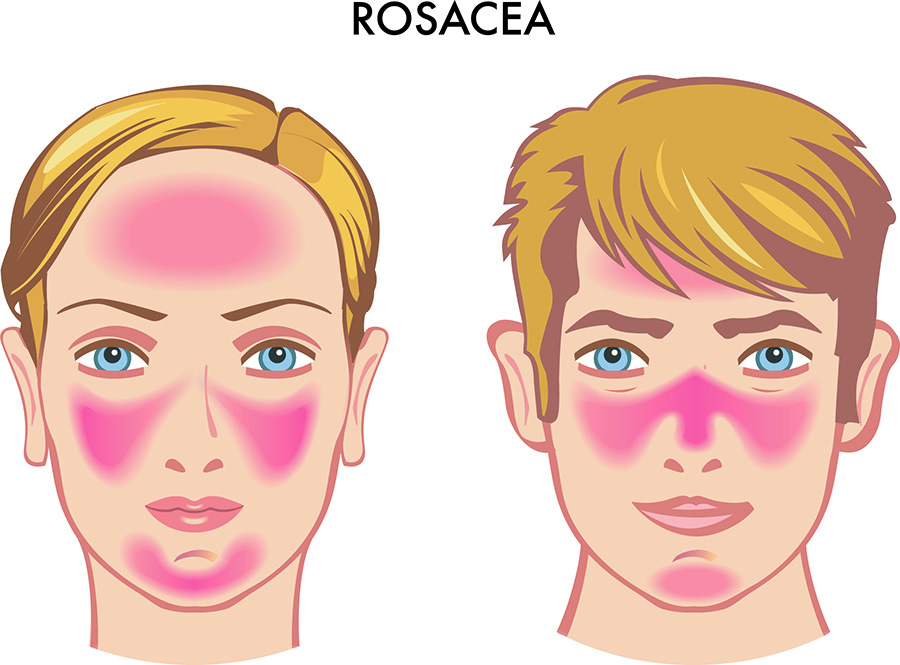 rosacea-cuperosis-rojez-venitas-rojas-pomulos-cara-tratamiento-laser-ellypse-nordlys-dermatologia-dermatologo-dr-lopez-gil-clinica-teknon-barcelona-