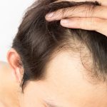 ¿Sabes cúales son los tratamientos más efectivos para combatir la alopecia masculina?